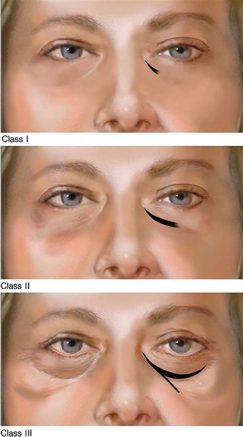 figure   tear trough deformity review  anatomy  treatment