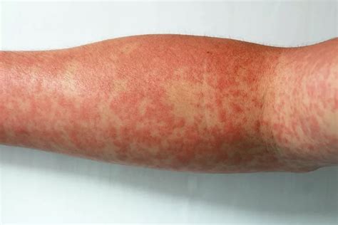Como Fica A Pele Com Dengue - Dengue: Sintomas, Causas e Tratamentos
