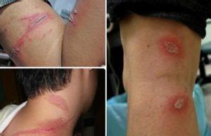 Bicho Que Queima A Pele - Conheça o Potó o inseto que causa queimaduras na pele! | Dermatolaser