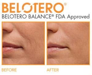 Belotero Los Angeles • Osman Dermatology
