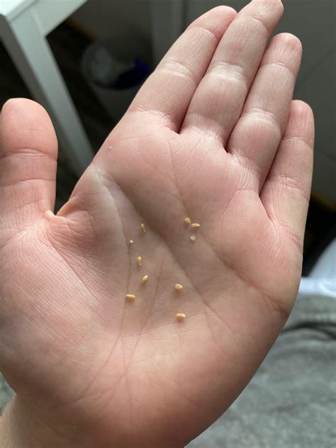 Why Am I Pooping Sesame Seeds at Savannah Holroyd blog