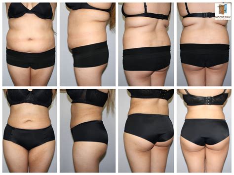 Brazilian Butt Lift | Lipo 360 | Mansfield Cosmetic Surgery Center - EU ...