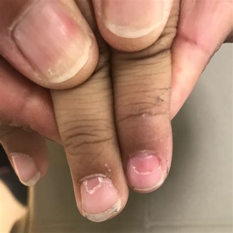 Damaged Nail Matrix Treatment