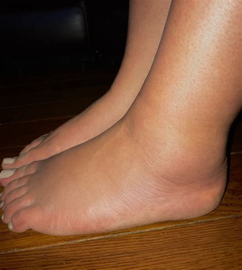 What you should know about swelling in your legs – Artofit