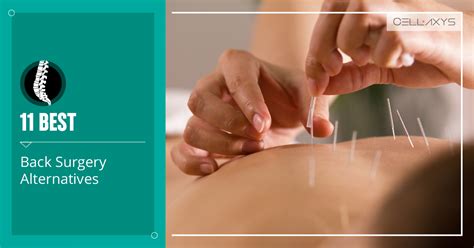 9 Effective Alternatives To Disc Replacement Surgery - Cellaxys