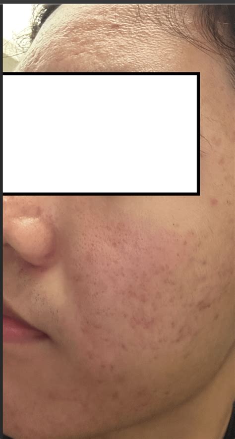 What os this? It appeared on my cheek overnight. : r/AcneTreatments