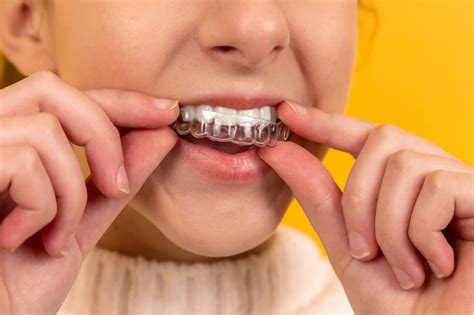 reasons   invisible braces  affordable dentist sydney