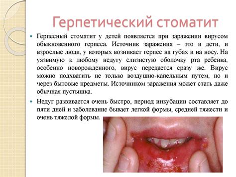 Стоматиты у детей - презентация онлайн