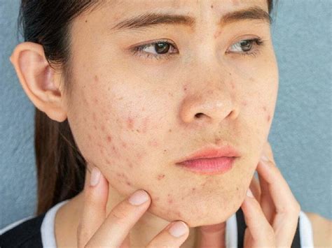pimples  face