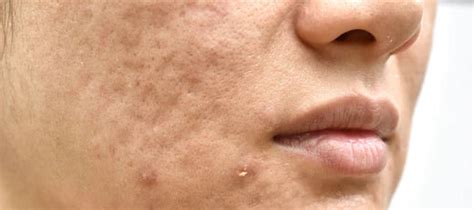 How To Fill Acne Holes On Face: Our Top Tips - The Pink Foundry