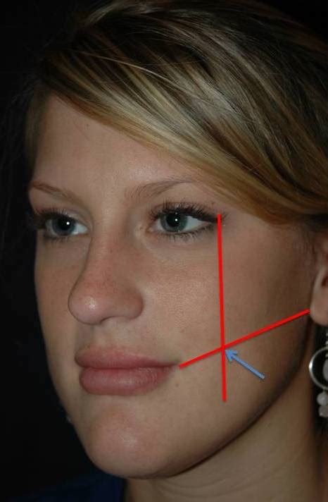 dimple creation evans  augusta georgia dimpleplasty