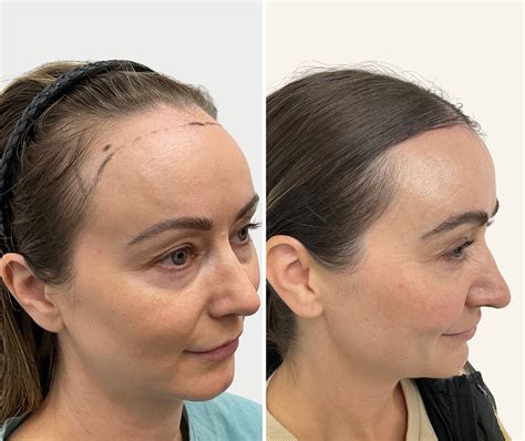 forehead reduction surgery perth hairline lowering surgery