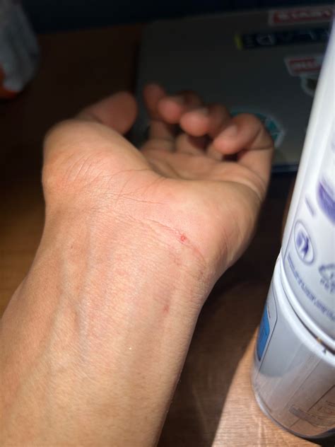 gatal diseluruh badan hellosehat