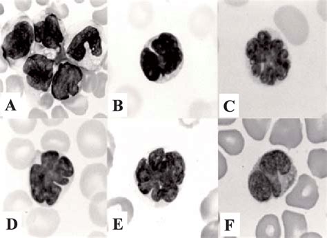Abnormal circulating lymphocytes with convoluted or lobulated nuclei ...