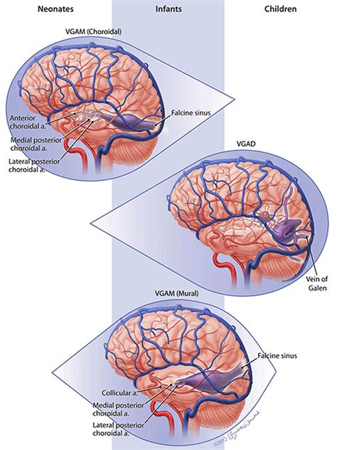 Vein of Galen malformation causes, symptoms, diagnosis, treatment ...