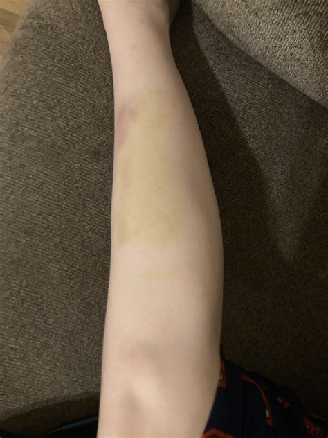 Can you see it? : r/bruises