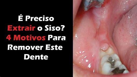 Dente Siso Doendo O Que Fazer - 4 Motivos Para Extrair o Dente do Siso - Porque a Extração é o Melhor ...