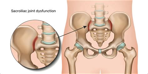 Sacroiliac joint dysfunction sij d | Sacroiliac joint pain exercises ...