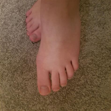 Im a teenager, how do I fix my bunions? Are they severe? : r/bunions