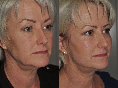Face / Neck Lift - Julian LoftsJulian Lofts