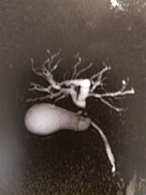 Klatskin tumor incorrectly resected. What to do next?