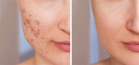 Pimple Treatment - Dr Manisha Mareddy - Best Cosmetic Dermatologist, Dermatosurgeon & Trichologist