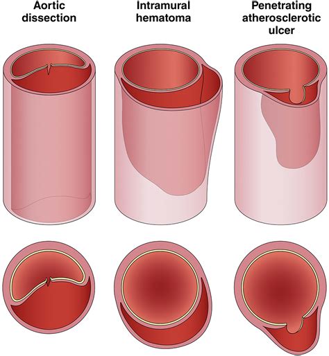 accaha guideline   diagnosis  management  aortic