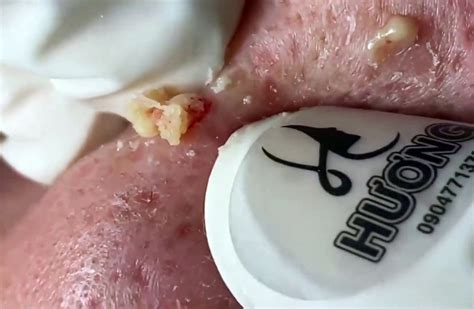 Say Goodbye to Blackheads with Unbelievable Blackhead Removal 2024 - ly838ph