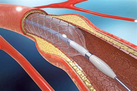 interventional tullamed