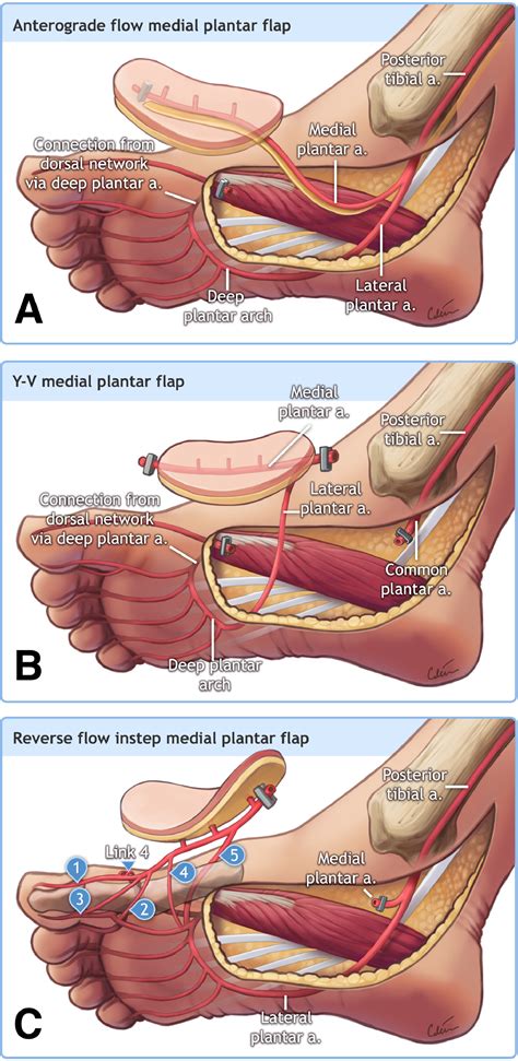 Plantar Foot Reconstruction at Terrance Mitchell blog