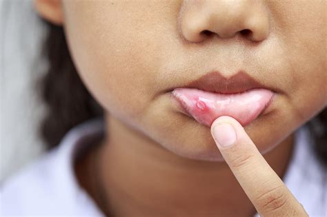 Canker Sores: MedlinePlus
