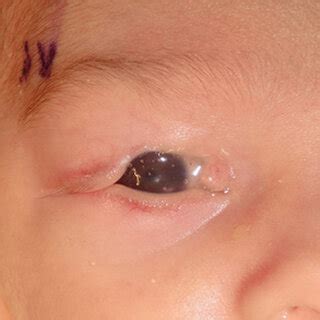 Large upper eyelid coloboma in neonatal patient with inferior corneal ...