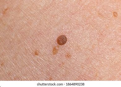 papillomatosis images stock  vectors shutterstock