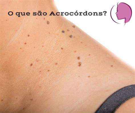 Acrocórdons O Que É - Acrocórdons fibroma mole - Dra. Cinthia Orasmo - Dermatologista em ...