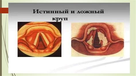 Круп синдромы - презентация онлайн