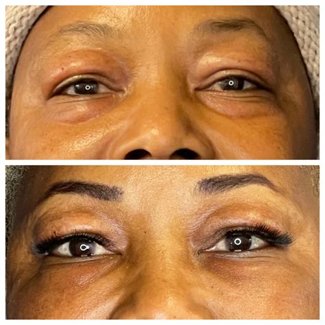 how to fix eyelid bags