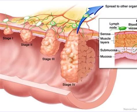 Stages of Colorectal Cancer | Colorectal Cancer Alliance