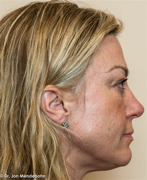 Upper Blepharoplasty (Upper Eyelid Lift) – Advanced Cosmetic Surgery