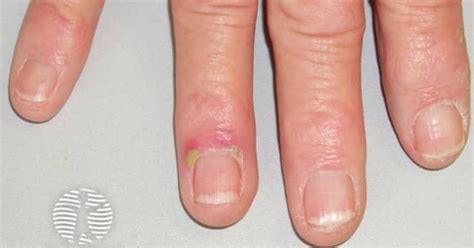 paronychia image