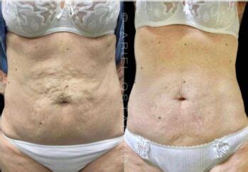 Morpheus8 Body Before and After the Treatment