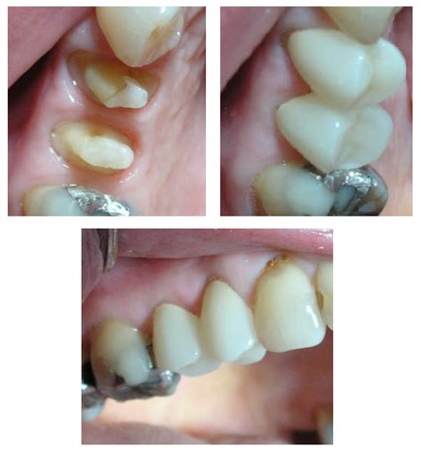 dental crowns bridges northcote natural lasting results ocean