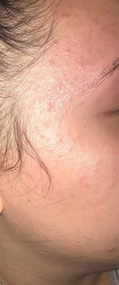 [Skin Concern] Itchy, burning skin : r/SkincareAddiction