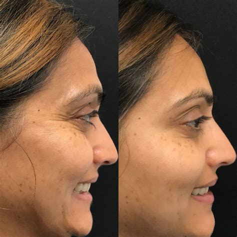The Truths and Myths About Botox — Cinderella Bridez