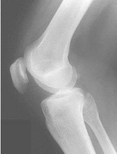 diagram  lateral knee quizlet
