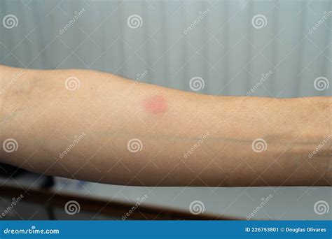 Skin Test 14mm: Positive Protein Derivate PPD In A 42 Years Old Female ...