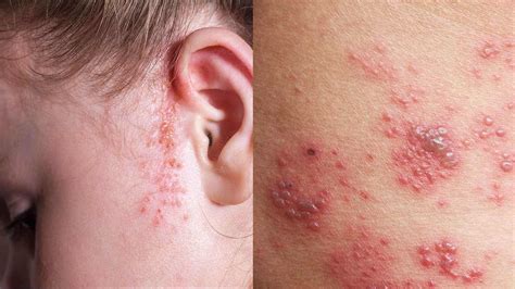 unraveling  mystery rashes  detoxification symptoms heidi salon