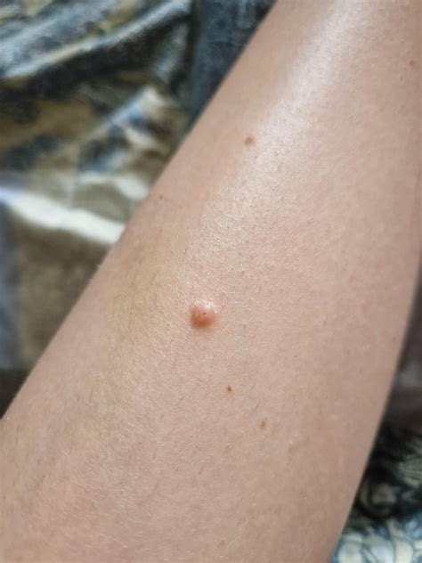 bump  leg rdermatologyquestions