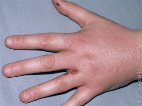 Spider Bite Pictures: How to Identify a Spider Bite - GoodRx