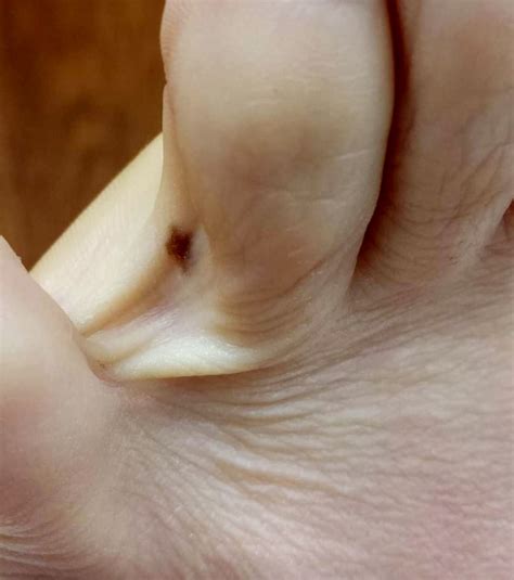 Toe Nail Melanoma Treatment at James Jain blog