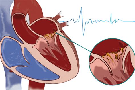 What should you know about Infective Endocarditis: Corrielus Cardiology ...